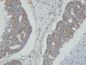 Immunohistochemical analysis of paraffin embedded endo mitral OVCA tissue, labelling N myc interactor with ab137555 at 1/100 dilution.