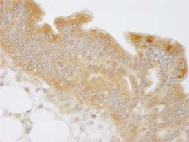 ab84553, at a 1/250 dilution, staining N myc interactor in formalin fixed, paraffin embedded human mucinous ovarian carcinoma by Immunohistochemistry, using DAB detection.
