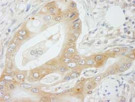 ab84553, at a 1/250 dilution, staining N myc interactor in formalin fixed, paraffin embedded human colon adenocarcinoma by Immunohistochemistry, using DAB detection.