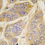 ab65203 at 1/50 dilution staining Nanos Homologue 1 in human breast carcinoma tissue section by Immunohistochemistry (Formalin/ PFA fixed paraffin-embedded sections). A peroxidase conjugated secondary antibody was used followed by DAB staining.