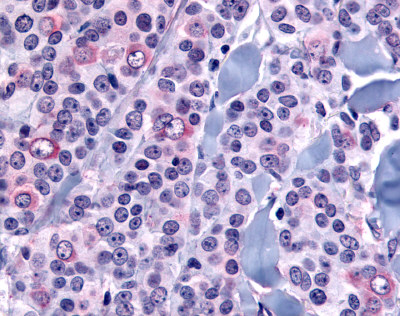 ab61029 at 8µg/ml staining formalin fixed paraffin embedded neoplastic cells