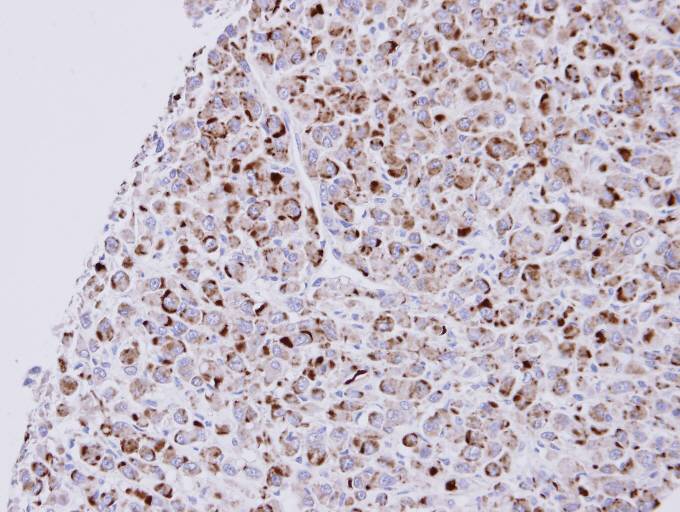 ab97389, at a 1/500 dilution, staining Natriuretic Peptide Receptor C in paraffin embedded U87 xenograft by Immunohistochemistry.