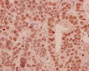 Immunohistochemical analysis of paraffin-embedded Human ovarian carcinoma tissue labeling HLTF with ab183042 at 1/100 dilution followed by pre-diluted HRP-conjugated secondary antibody and counter-stained with Hematoxylin.