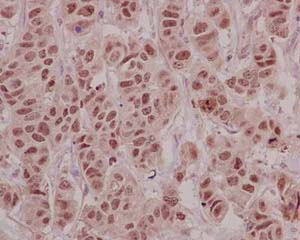 Immunohistochemical analysis of paraffin-embedded Human infiltrating duct carcinoma of breast tissue labeling HLTF with ab183042 at 1/100 dilution followed by pre-diluted HRP-conjugated secondary antibody and counter-stained with Hematoxylin.