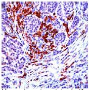 ab27432, prediluted, staining Nck beta in paraffin embedded, formalin fixed human breast carcinoma by Immunohistochemistry.