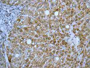 Immunohistochemical analysis of paraffin embedded Human liver tissue labeling Ndufs1 with ab169540 antibody at 1/50.