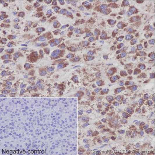Immunohistochemical analysis of paraffin-embedded Human hepatocellular carcinoma tissue labeling NDUFS6 with ab195807 at 1/500. Secondary antibody: Goat Anti-Rabbit IgG H&L (HRP) (ab97051) at 1/500.Inset image: negative control obtained using PBS instead of ab195807 and secondary antibody only.Note: Cytoplasm staining on human hepatocellular carcinoma tissue was observed.
