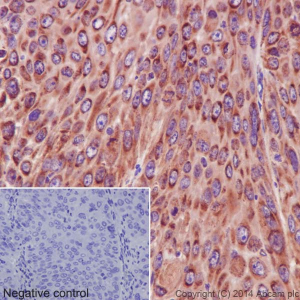 Immunohistochemical analysis of paraffin-embedded Human cervix squamous cell carcinoma tissue labeling NDUFS6 with ab195808 at 1/500 dilution followed by Goat Anti-Rabbit IgG H&L (HRP) (ab97051) at 1/500 dilution and counter-stained with Hematoxylin. (inset: negative control).Note: Cytoplasm staining on human squamous cell carcinoma of cervix tissue was observed.