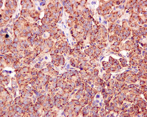 Immunohistochemical analysis of paraffin-embedded Human thyroid carcinoma tissue labeling NDUFS8 with ab170936 at 1/250 dilution.