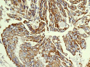 Immunohistochemical analysis of paraffin embedded Human endometrial carcinoma tissue labeling NDUFS8 with ab180183 at 1/50.