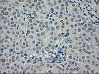 ab117986, at 1/50 dilution, staining NEK6 in paraffin-embedded Human breast adenocarcinoma tissue by Immunohistochemistry.