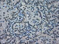 ab117986, at 1/50 dilution, staining NEK6 in paraffin-embedded Human kidney carcinoma tissue by Immunohistochemistry.