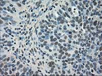 ab117986, at 1/50 dilution, staining NEK6 in paraffin-embedded Human ovary adenocarcinoma tissue by Immunohistochemistry.