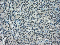 ab117986, at 1/50 dilution, staining NEK6 in paraffin-embedded Human thyroid carcinoma tissue by Immunohistochemistry.