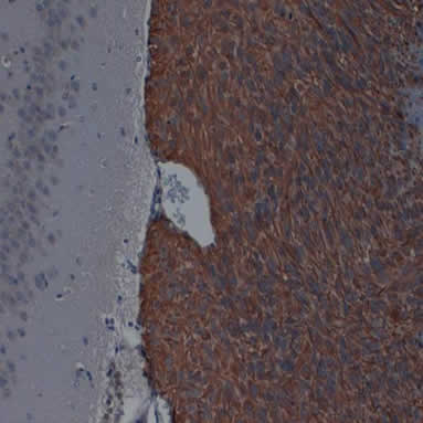 Immunohistochemistry (Formalin/PFA-fixed paraffin-embedded sections) analysis of xenograft tumor cells labelling Nestin with ab18102.