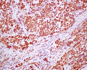 Immunohistochemical analysis of paraffin-embedded Human melanoma tissue labeling Nestin using ab176571 at a 1/250 dilution.