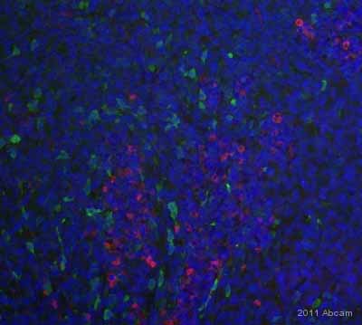 ab105389 staining Nestin in human melanoma tissue by Immunohistochemistry (Formalin/PFA-fixed paraffin-embedded sections).Tissue was fixed in formaldehyde and a heat mediated antigen retrieval step was performed using Tris EDTA pH 9.0. Samples were then permeabilized using 0.25% Triton X-100, blocked, then incubated with ab105389 at a 1/100 dilution for 18 hours at 4°C. The secondary used was an Alexa-Fluor 594 (red) conjugated donkey anti-rabbit polyclonal used at a 1/100 dilution. (Green) tumor cells, (blue) DAPI.See Abreview