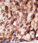 ab76684, at a 1/50 dilution, staining Nestin in formalin fixed, paraffin embedded human breast carcinoma tissue by Immunohistochemistry. A peroxidase conjugated secondary antibody was then used, followed by DAB staining.