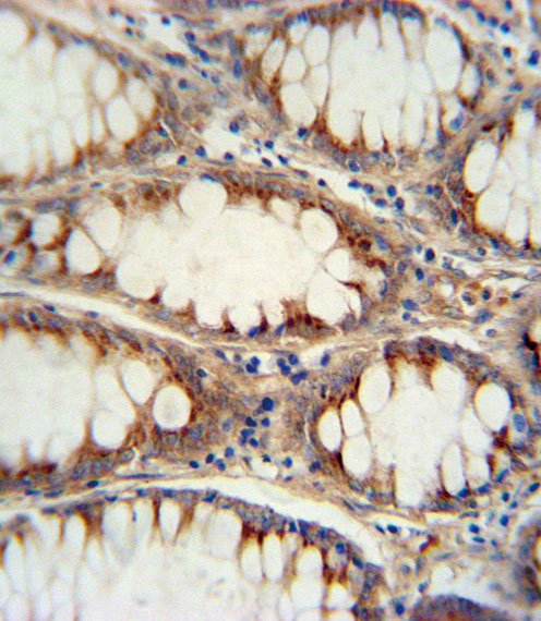 Immunohistochemistry (Formalin/PFA-fixed paraffin-embedded sections) analysis of human large intestine tissue labelling Neurogenin3 with ab38548. A peroxidase-conjugated anti-rabbit IgG was used as the secondary antibody, followed by DAB staining.