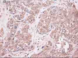 ab124410 at 1/50 dilution staining Neurotrophin 3 in Paraffin-embedded Human breast adenocarcinoma tissue by Immunohistochemistry.