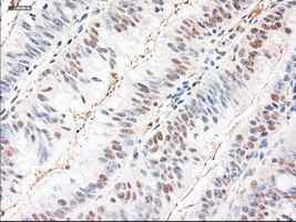 ab124410 at 1/50 dilution staining Neurotrophin 3 in Paraffin-embedded Human colon adenocarcinoma tissue by Immunohistochemistry.