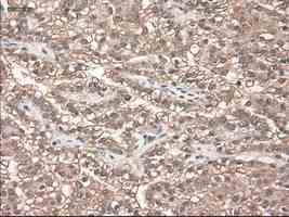 ab124410 at 1/50 dilution staining Neurotrophin 3 in Paraffin-embedded Human kidney carcinoma tissue by Immunohistochemistry.