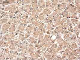 ab124410 at 1/50 dilution staining Neurotrophin 3 in Paraffin-embedded Human liver carcinoma tissue by Immunohistochemistry.