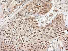 ab124410 at 1/50 dilution staining Neurotrophin 3 in Paraffin-embedded Human lung carcinoma tissue by Immunohistochemistry.
