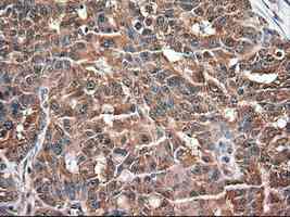 ab124410 at 1/50 dilution staining Neurotrophin 3 in Paraffin-embedded Human ovary adenocarcinoma tissue by Immunohistochemistry.
