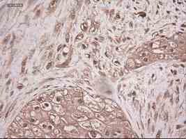 ab124410 at 1/50 dilution staining Neurotrophin 3 in Paraffin-embedded Human pancreas carcinoma tissue by Immunohistochemistry.
