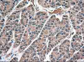 ab124410 at 1/50 dilution staining Neurotrophin 3 in Paraffin-embedded Human thyroid carcinoma tissue by Immunohistochemistry.