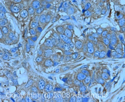 IHC image of NF-kB p65 staining in human breast carcinoma FFPE section, performed on a BondTM system using the standard protocol F. The section was pre-treated using heat mediated antigen retrieval with sodium citrate buffer (pH6, epitope retrieval solution 1) for 20 mins. The section was then incubated with ab16502, 1µg/ml, for 8 mins at room temperature and detected using an HRP conjugated compact polymer system. DAB was used as the chromogen. The section was then counterstained with haematoxylin and mounted with DPX.