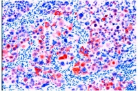 ab776 - immunohistochemistry Formalin fixed paraffin embedded human colon carcinoma stained with HMW Cytokeratin, using ABC and AEC chromagen.