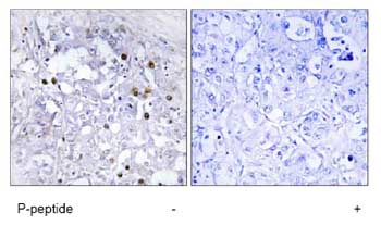 Immunohistochemistry analysis of paraffin-embedded human liver carcinoma tissue using ab78356 at a 1/50 dilution.Left image un-treated.Right image treated with immunizing peptide.