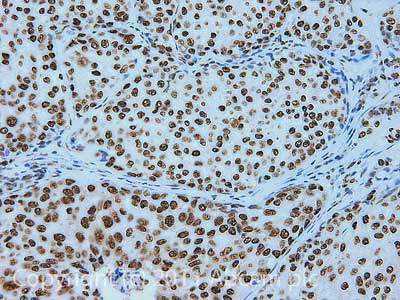 IHC image of ab24409 staining in Human breast adenocarcinoma formalin fixed paraffin embedded tissue section, performed on a Leica BondTM system using the standard protocol F. The section was pre-treated using heat mediated antigen retrieval with sodium citrate buffer (pH6, epitope retrieval solution 1) for 20 mins. The section was then incubated with ab24409, 1µg/ml, for 15 mins at room temperature and detected using an HRP conjugated compact polymer system. DAB was used as the chromogen. The section was then counterstained with haematoxylin and mounted with DPX.For other IHC staining systems (automated and non-automated) customers should optimize variable parameters such as antigen retrieval conditions, primary antibody concentration and antibody incubation times.