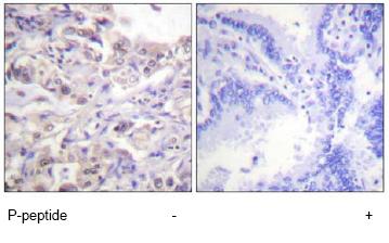 1/50-1/100 ab61096 staining phosphorilated hnRNP D/AUF1 on human lung carcinoma tissue sections, in the absence or presence of the immunizing phosphopeptide.