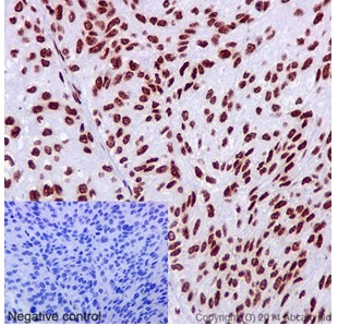 Immunohistochemical analysis of paraffin-embedded human transitional cell carcinoma of bladder tissue labeling hnRNP G with ab190352 at 1/250 dilution. Counter stain Hematoxylin. Negative control also shown lower left.