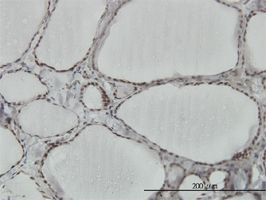 hnRNP M3-M4 antibody (ab55486) used in immunohistochemistry at 3ug/ml on formalin fixed and paraffin embedded human thyroid nodular goiter.