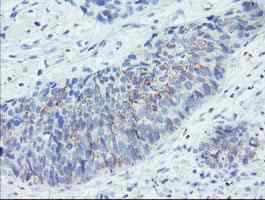 ab128492, at a dilution of 1/150, staining HGFA Inhibitor 1 in paraffin-embedded Carcinoma of Human lung tissue by Immunohistochemistry.