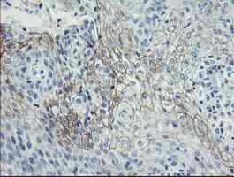 ab128492, at a dilution of 1/150, staining HGFA Inhibitor 1 in paraffin-embedded Carcinoma of Human bladder tissue by Immunohistochemistry.