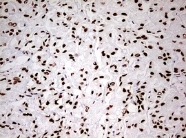 Immunohistochemical analysis of paraffin embedded Carcinoma of Human prostate tissue labeling HNRNPM with ab180530 at 1/150.