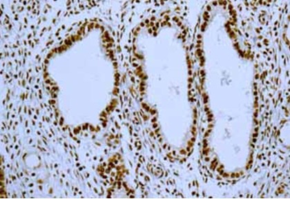 Immunohistochemical analysis of paraffin-embedded Human Endometrium tissue labeling HNRPH2 with ab181171at 1/250 dilution. Secondary antibody:anti rabbit IgG (HRP) prediluted. Counter stain Hematoxylin.