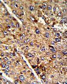 Immunohistochemical analysis of Formalin-fixed, Paraffin-embedded Human hepatocarcinoma tissue labelling Homer with ab135644 at 1/50 dilution followed by peroxidase-conjugated secondary antibody and DAB staining.