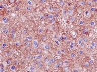 Immunohistochemical analysis of paraffin-embedded Human gliocytoma labeling Homer with ab184955 at 1/500 dilution and HRP Polymer for Rabbit IgG. Counterstained with Hematoxylin.