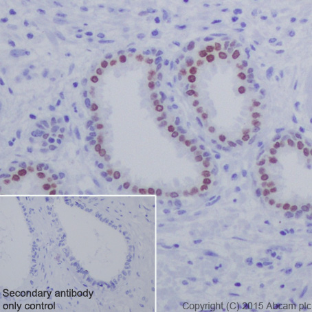 Immunohistochemical analysis of paraffin-embedded Human carcinoma of prostate tissue labeling HOXB13 with ab201682 at 1/3000 dilution, followed by Goat Anti-Rabbit IgG H&L (HRP) (ab97051) secondary antibody at 1/500 dilution. Nuclear staining on Human carcinoma of prostate tissue is observed. Counter stained with Hematoxylin.Secondary antibody only control: Used PBS instead of primary antibody, secondary antibody is Goat Anti-Rabbit IgG H&L (HRP) (ab97051) at 1/500 dilution.