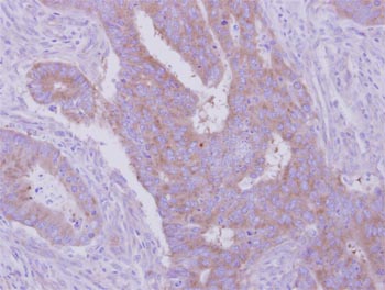 Immunohistochemical analysis of paraffin-embedded Human colon cancer tissue, labeling HGS with ab155539 at 1/500 dilution.