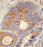 Immunohistochemistry analysis of formalin fixed and paraffin embedded Human prostate carcinoma tissue labeling HHAT using ab174944 at a 1/50 dilution, followed by peroxidase conjugation of the secondary antibody and DAB staining.