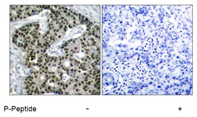 ab47369 (1/50) staining HSF1 in paraffin-embedded human breast carcinoma tissue. Right-hand panel corresponds to a negative control for which ab47369 was pre-incubated with the immunising (blocking) peptide.