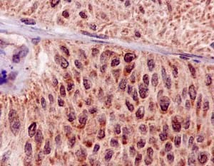 Immunohistochemical analysis of paraffin-embedded Human transitional cell carcinoma of bladder tissue labeling Hsp20 with ab188864 at 1/100 dilution followed by prediluted HRP Polymer for Rabbit IgG. Counter stained with Hematoxylin.