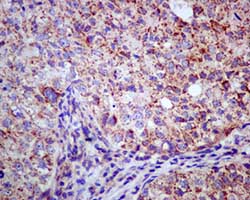 Immunohistochemical analysis of paraffin-embedded Human breast carcinoma tissue labeling HIBADH with ab172955 at 1/100 dilution.